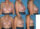 Before & After pictures of breast reduction